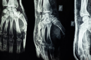 x ray